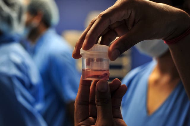 <p>File. A doctor displays a piece of infected tissue after surgery to remove mucormycosis from a patient in Allahabad, India</p>